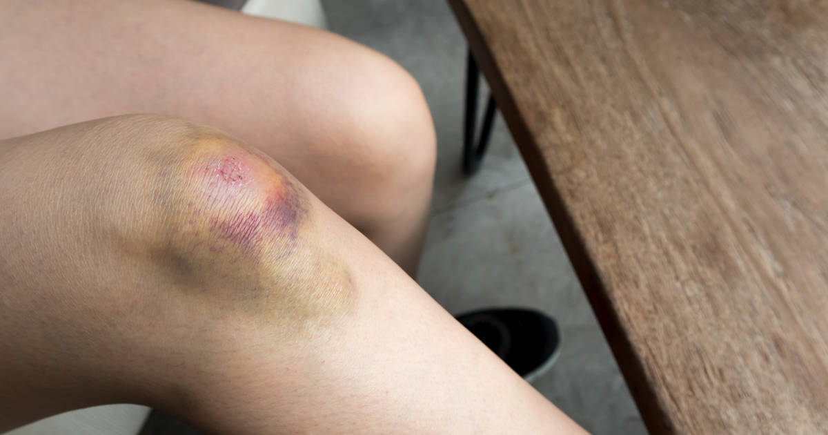 TrustCare | What is a Hematoma and is it Treated?