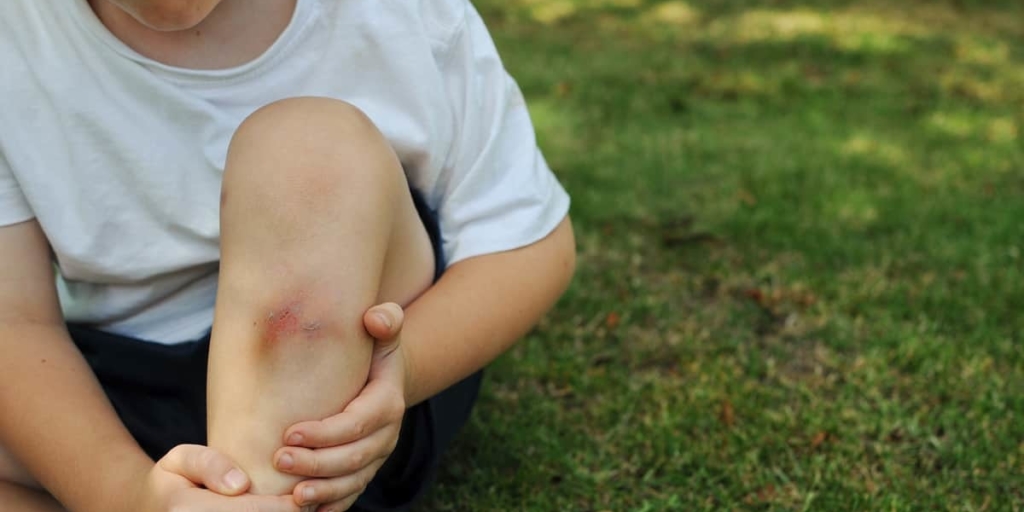 TrustCare | Kids' Health: Causes of Abnormal Bruising