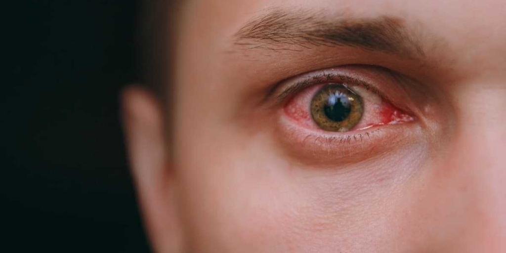 TrustCare  Pink Eye (Conjunctivitis): Symptoms, Causes, Treatment
